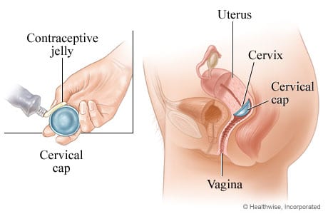 diaphragm insertion